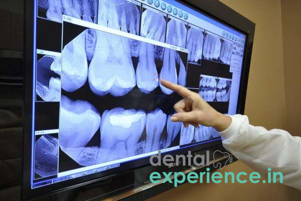 Digital XRays