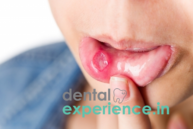 Big Ulcers