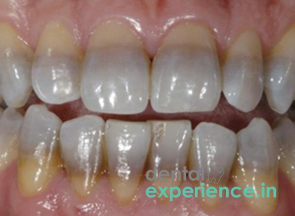 Tetracycline discoloration
