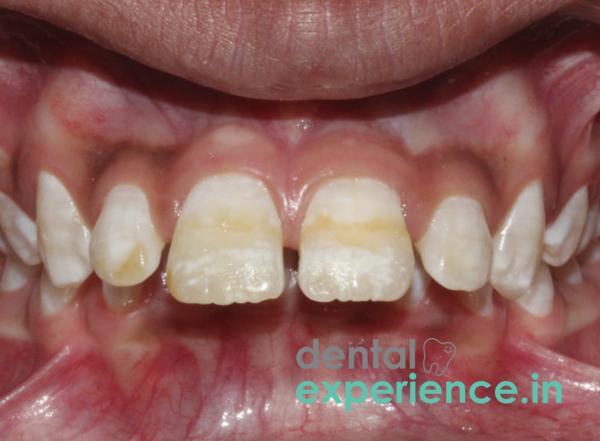 Fluorosis