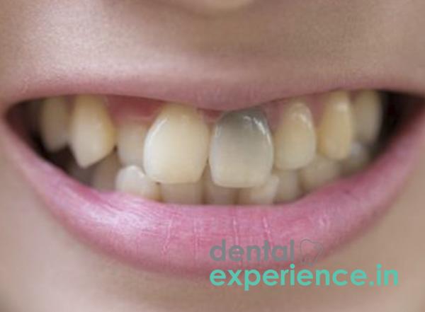 Dark tooth (after Accident)