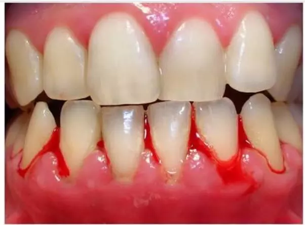Gum Bleeding