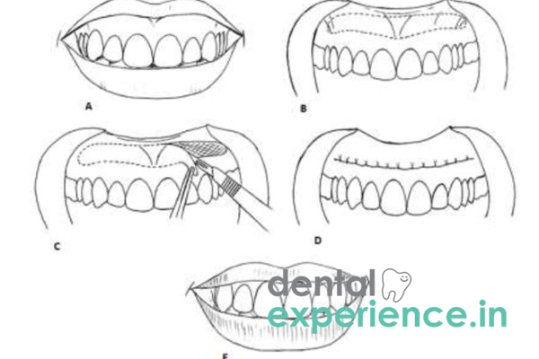 Lip Repositioning