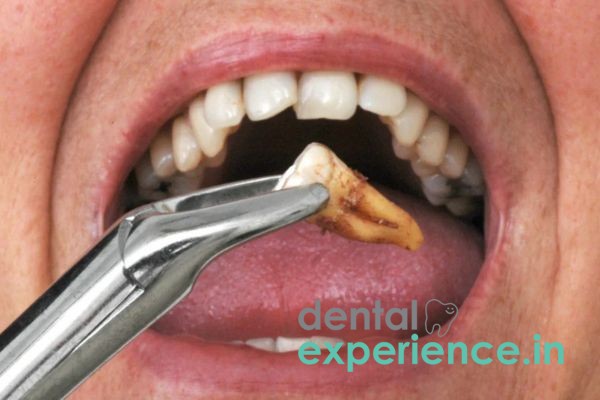 Wisdom Tooth Extraction