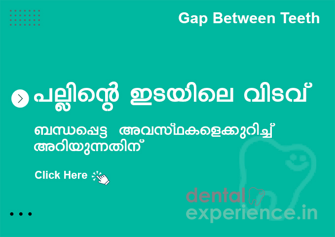 പല്ലുകൾക്കിടയിലുള്ള വിടവ്