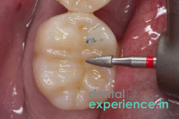 Occlusal Adjustments