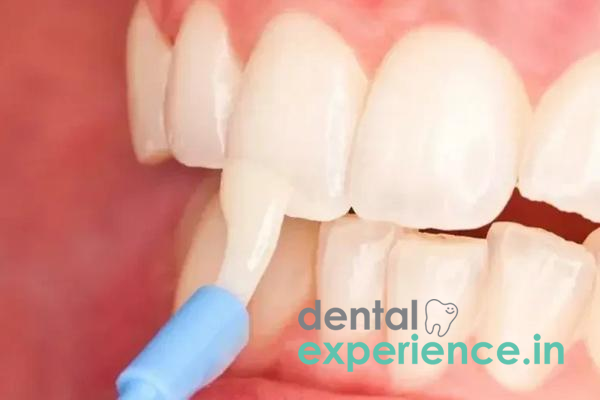 Fluoride Varnish Application