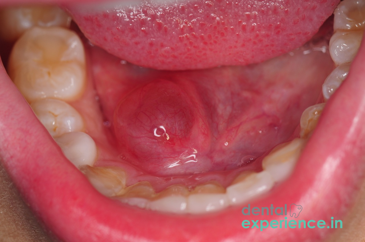 Swelling on floor of the mouth