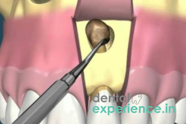Apicoectomy