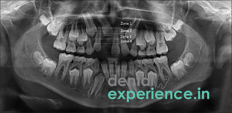 Un-erupted/Missing Tooth