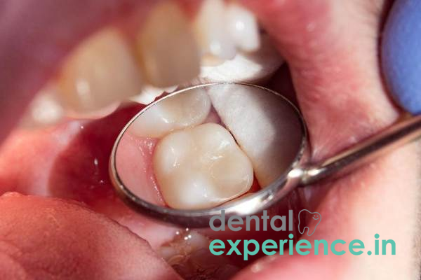 Tooth colored filling for decayed primary tooth.
