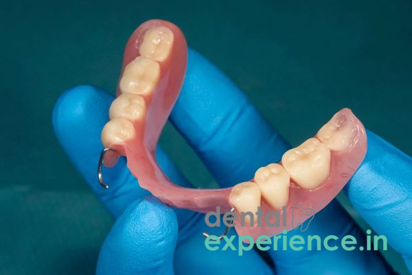 Removable Partial Denture