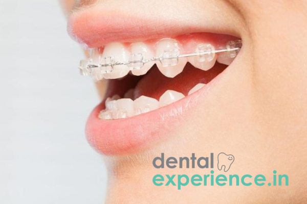 Ceramic Braces