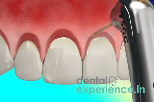 Crown Lengthening