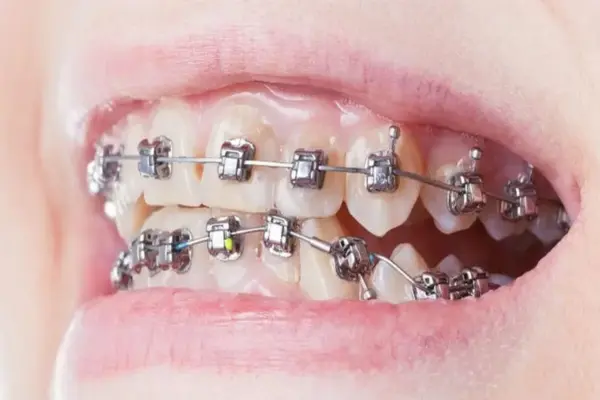 Self Ligating Braces