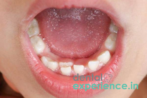 Extraction of retained primary teeth.
