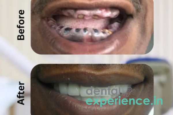 Smile Makeover & Smile Correction Treatment.
