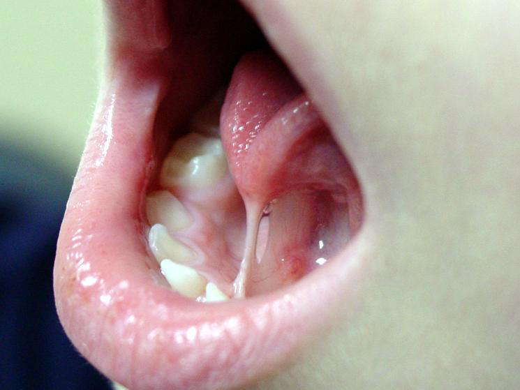 Tongue Tie