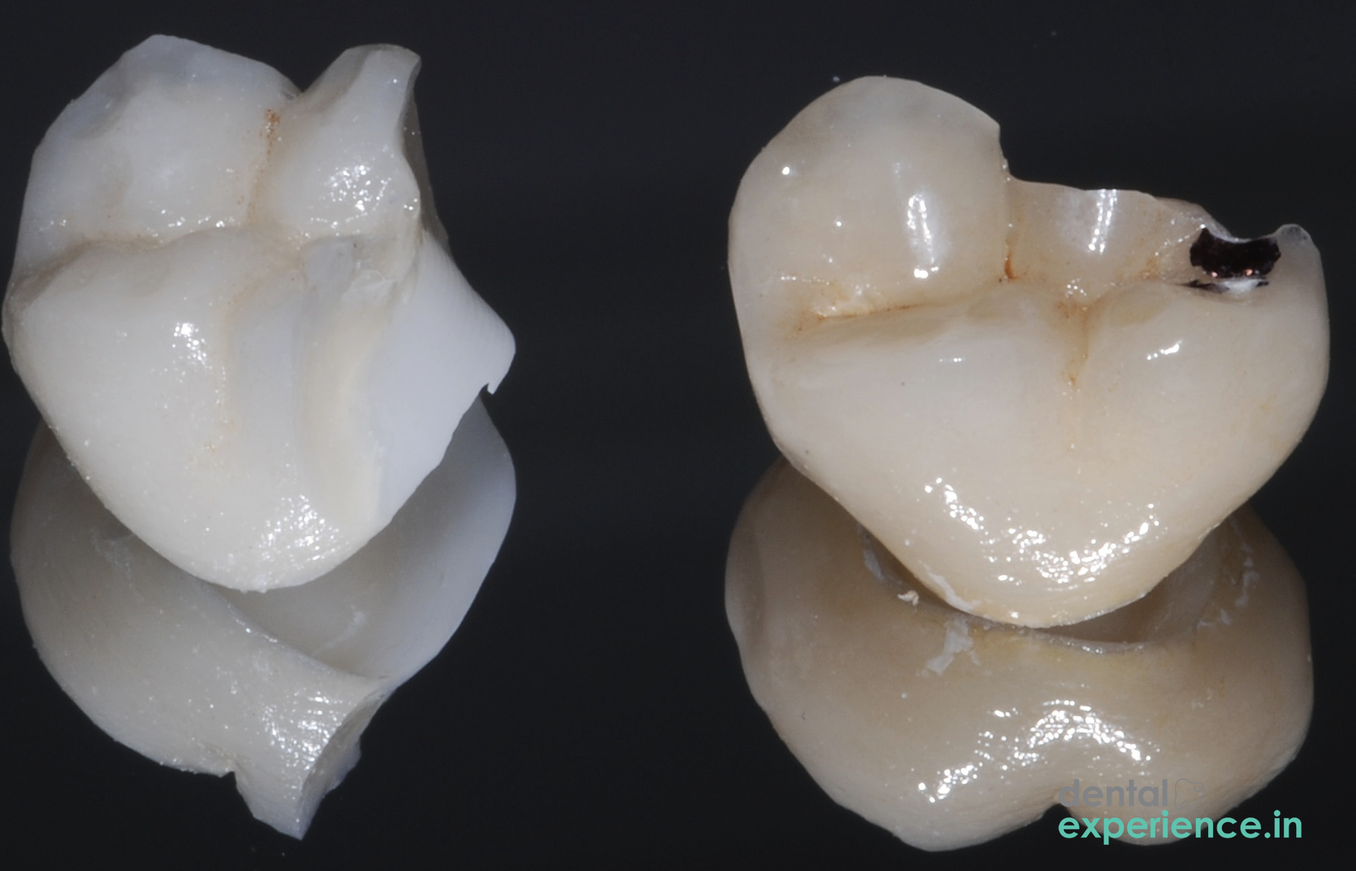 Ceramic Crown Fracture
