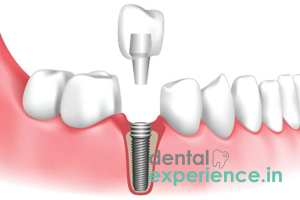 Dental Implant