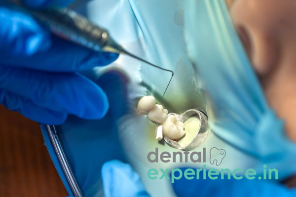 Temporary filling for broken Tooth
