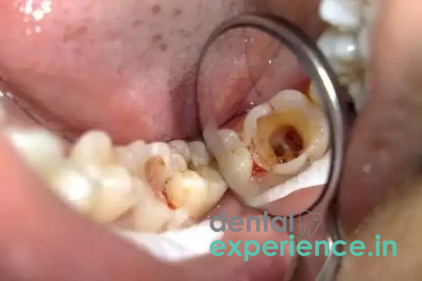 Pulpotomy