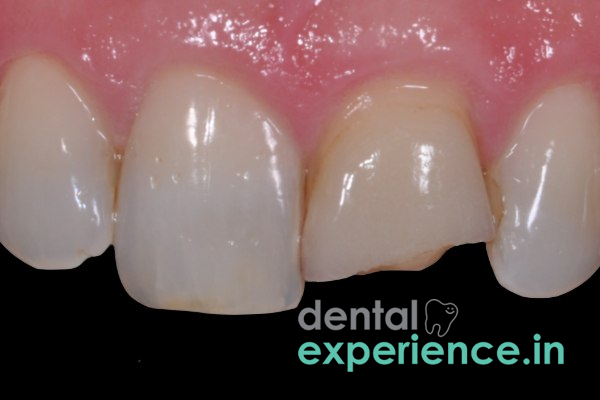 Repair of Chipped/ Broken Veneers