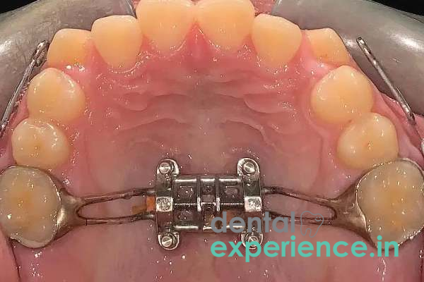 Palatal Expanders (Rapid/Slow)