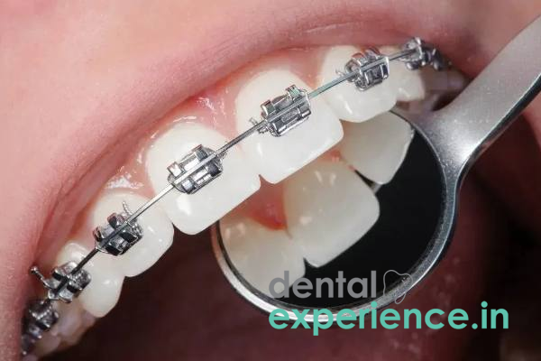 Metal Braces