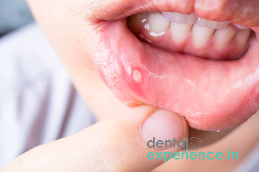 Ulcer on lip