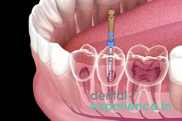 Re-Root Canal Treatment