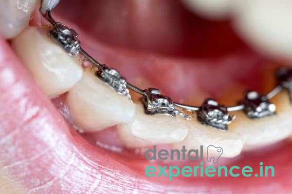 Lingual Braces