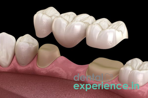 Metal Free Dental Bridges