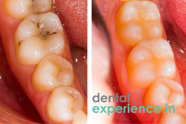 Glass Ionomer Filling