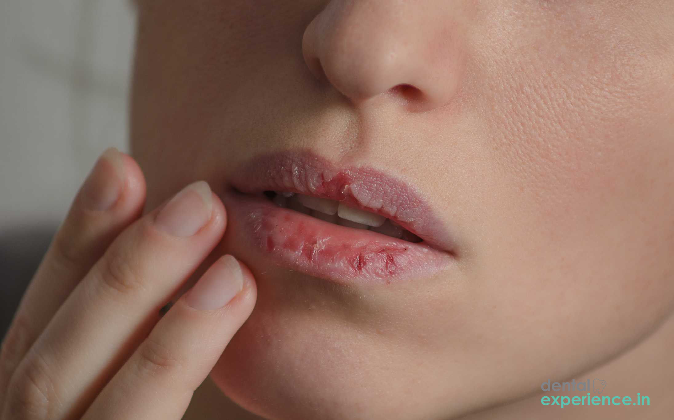 Dry Mouth