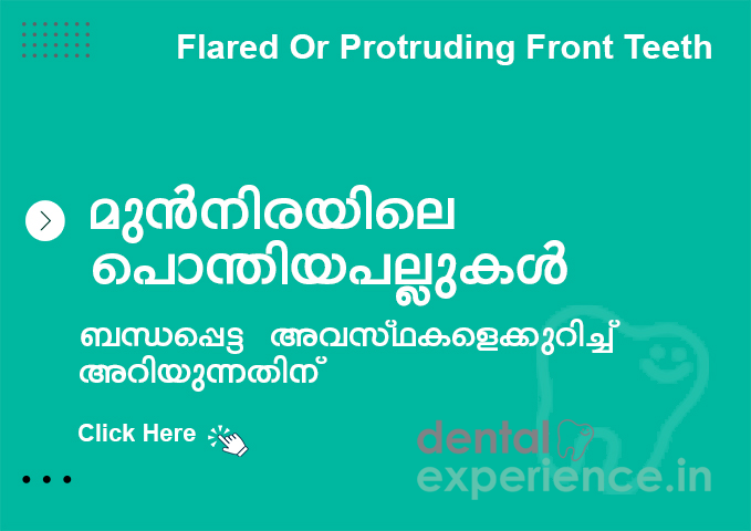 മുൻനിരയിലെ പൊന്തിയതും വിടർന്നതുമായ പല്ലുകൾ
