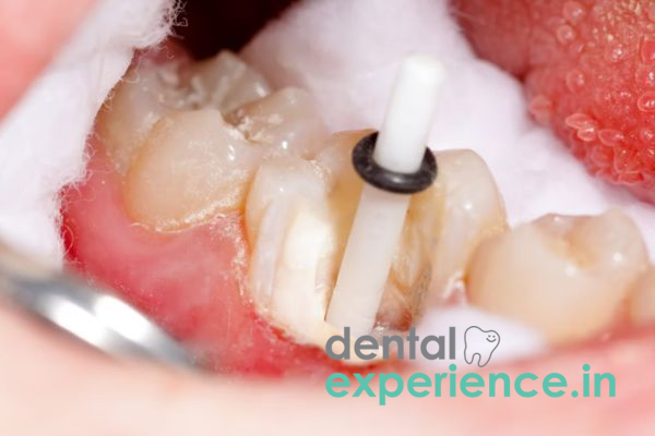 Post and Core Buildup