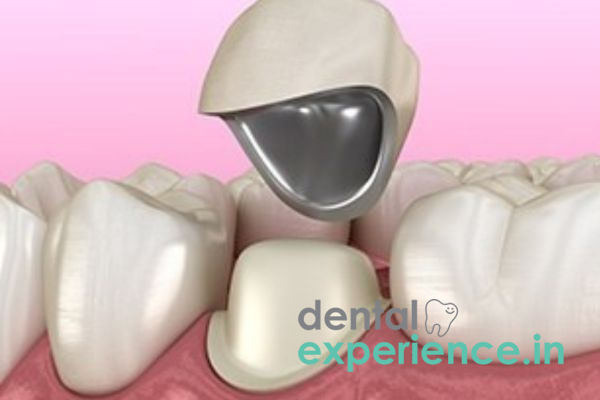 Metal Fused Ceramic Dental Crowns 