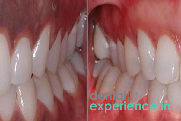 Gingival Depigmentation- Laser
