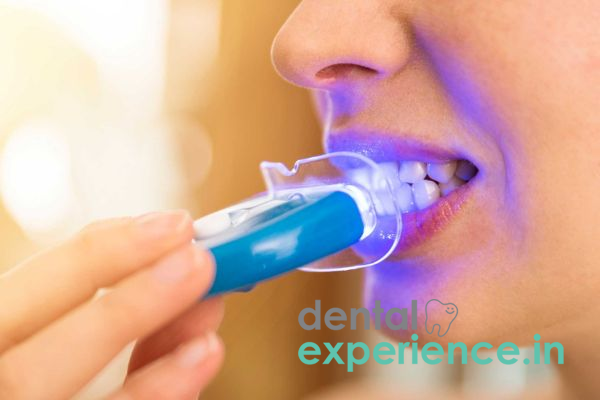 Home Teeth Whitening