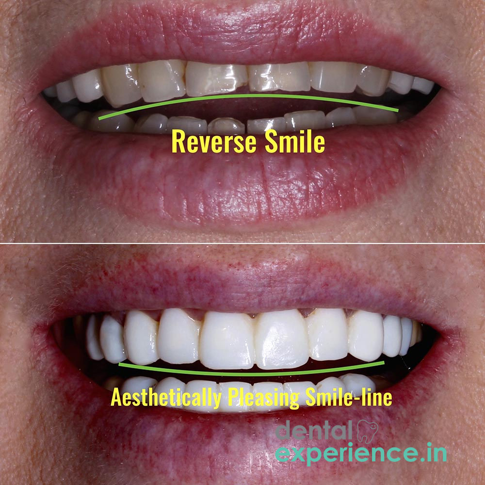 Negative Smile
